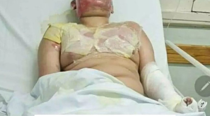 Niño sufre graves quemaduras tras explosión de experimento en feria científica