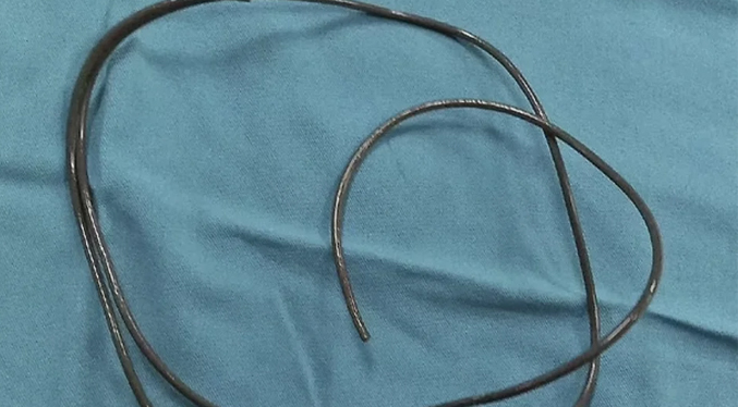 Encuentra 84 centímetros de cable en la vejiga de un hombre utilizado como «gratificación sexual»