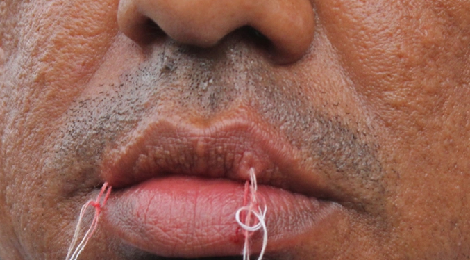 Venezolanos se cosen los labios en México para presionar la emisión de documentos legales