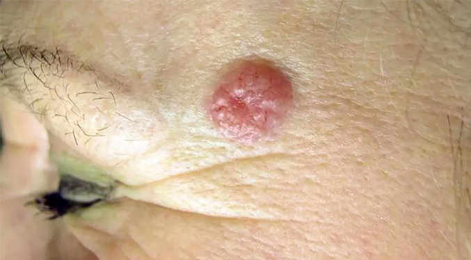 Estudio multiétnico sobre el melanoma da pistas sobre el origen del cáncer de piel