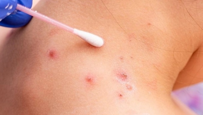 España confirma el primer fallecido en el país por viruela del mono