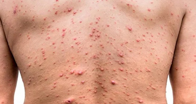 EEUU inicia pruebas para detección de viruela del mono