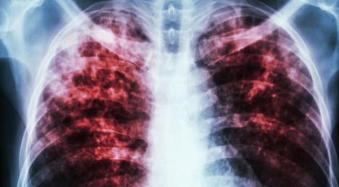 La OMS advierte que la tuberculosis vuelve a propagarse en el mundo