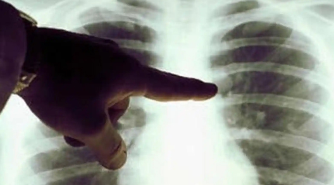 El cáncer de pulmón es la enfermedad con más muertes en el mundo