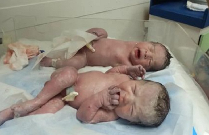 Nacen gemelos este 11-E en la maternidad Castillo Plaza de Maracaibo