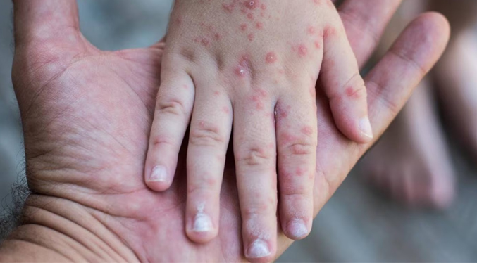 OMS alerta de la subida alarmante de casos de sarampión en Europa