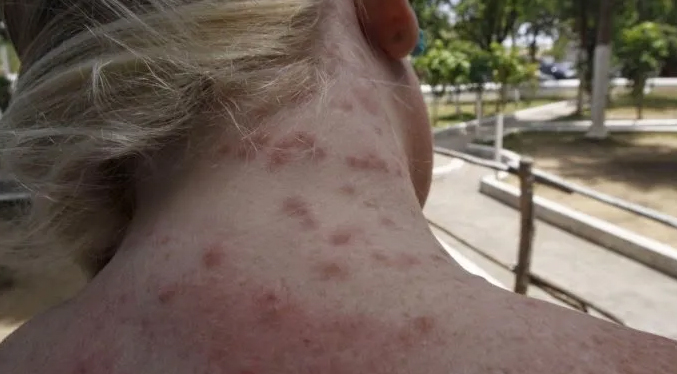 Gobierno combate daños causados en la piel por la plaga de la palometa peluda