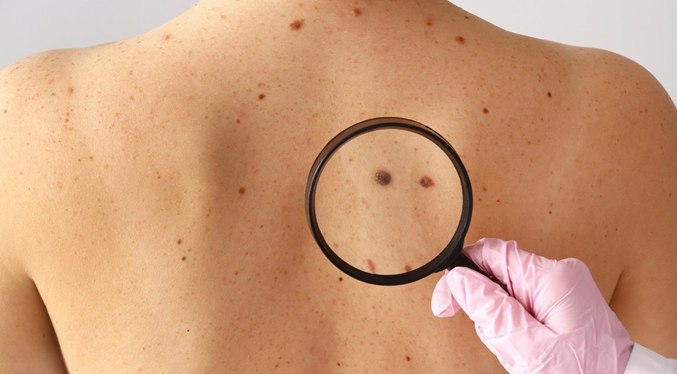 Científicos anuncia un descubrimiento contra el cáncer de piel