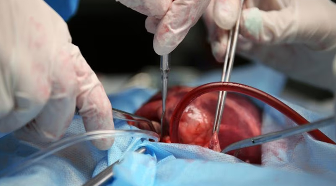 Realizan el primer trasplante de corazón que había dejado de latir durante 20 minutos