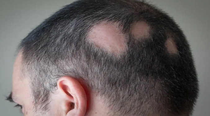 Prueban una posible vacuna contra la alopecia: ¿De qué se trata?