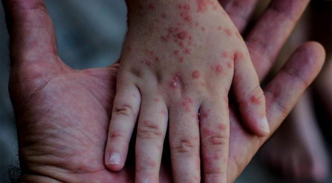 OMS insta a una respuesta urgente contra el sarampión en Europa