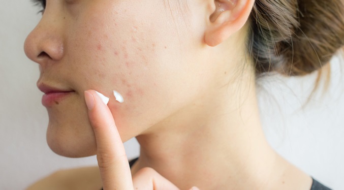 Una serie de remedios contra el acné podría causar cáncer
