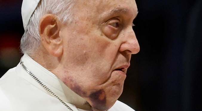 El Papa tiene un hematoma en el rostro tras golpearse con una mesa de noche