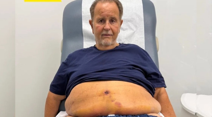 Raúl de Molina se sometió a una abdominoplastia por exceso de piel: «Se me abrió un poco la herida»