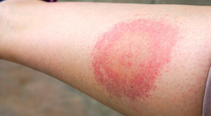 Picaduras de garrapatas y enfermedad de Lyme alcanzan picos significativos en EEUU