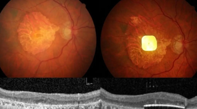 Prótesis ocular permite leer a personas con ceguera irreversible