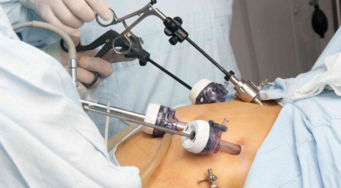 ¿Qué es la cirugía bariátrica y cuáles son sus ventajas?