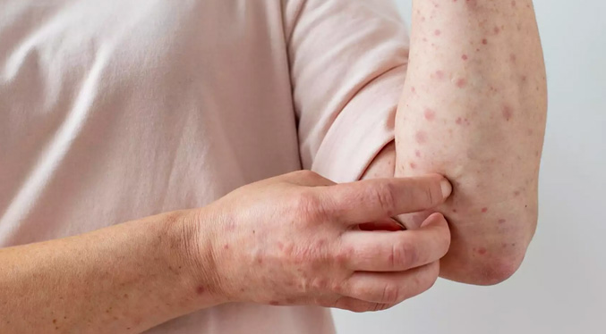 Paraguay reporta 218 casos de lepra en lo que va de 2025