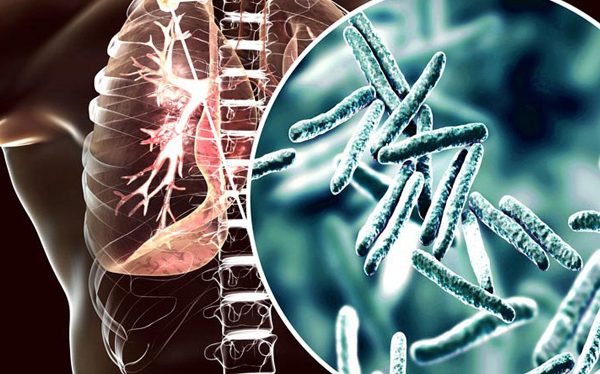 Muertes por tuberculosis bajan 3 % pero sigue siendo la infección más mortal