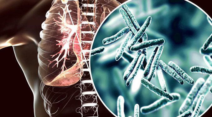 Muertes por tuberculosis bajan 3 % pero sigue siendo la infección más mortal