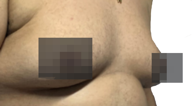 Hombre denuncia aumento de sus pechos tras consumir este medicamento