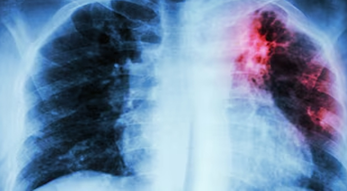 Fibrosis pulmonar es una secuela pospandemia