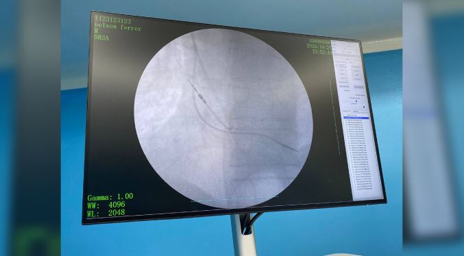 Minsalud y la Gobernación del Zulia fortalecen atención cardiovascular con la implantación de 71 marcapasos
